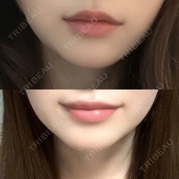 ヒアルロン酸注入（涙袋） / ヒアルロン酸注入（唇） ブルームクリニック（BLOOM CLINIC） AFTER メイン用