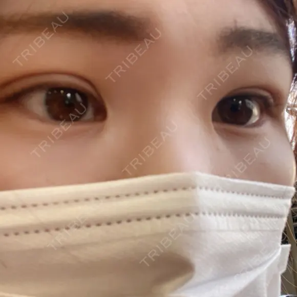 二重埋没 / 上まぶたの脂肪取り / 脂肪溶解注射（顔） TCB東京中央美容外科 前橋院 DAY 3 メイン用