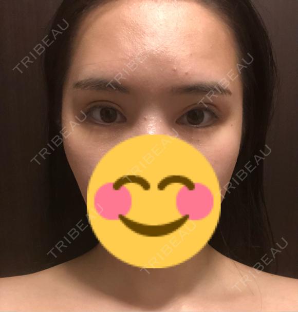 目頭切開 / 眼瞼下垂（切開） Otus Clinic 【オータスクリニック】 AFTER メイン用