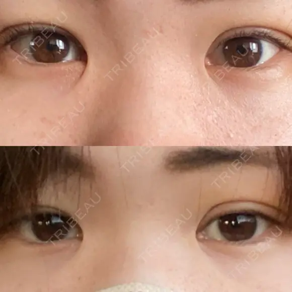 二重埋没 / 上まぶたの脂肪取り / 脂肪溶解注射（顔） TCB東京中央美容外科 前橋院 DAY 4 メイン用