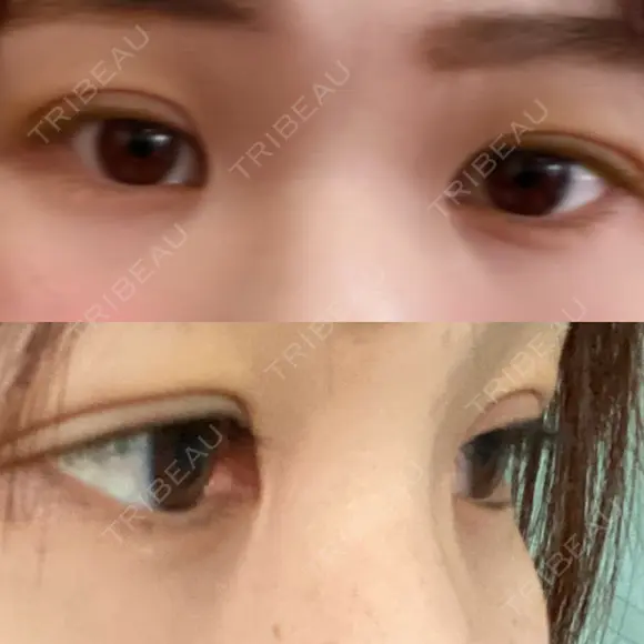 二重埋没 / 上まぶたの脂肪取り / 脂肪溶解注射（顔） TCB東京中央美容外科 前橋院 DAY 6 メイン用
