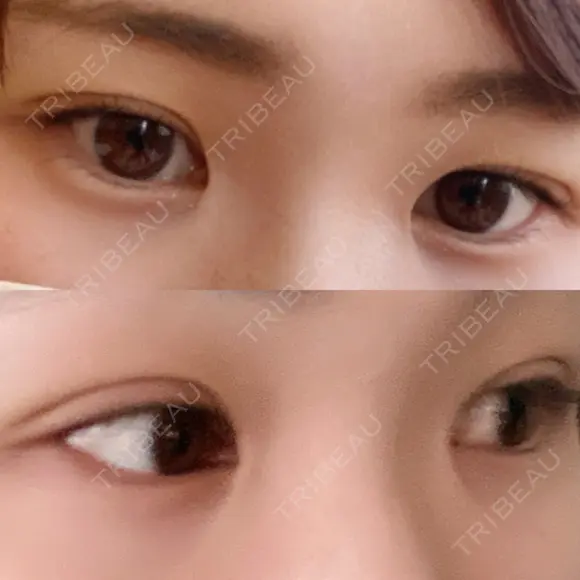 二重埋没 / 上まぶたの脂肪取り / 脂肪溶解注射（顔） TCB東京中央美容外科 前橋院 DAY 7 メイン用