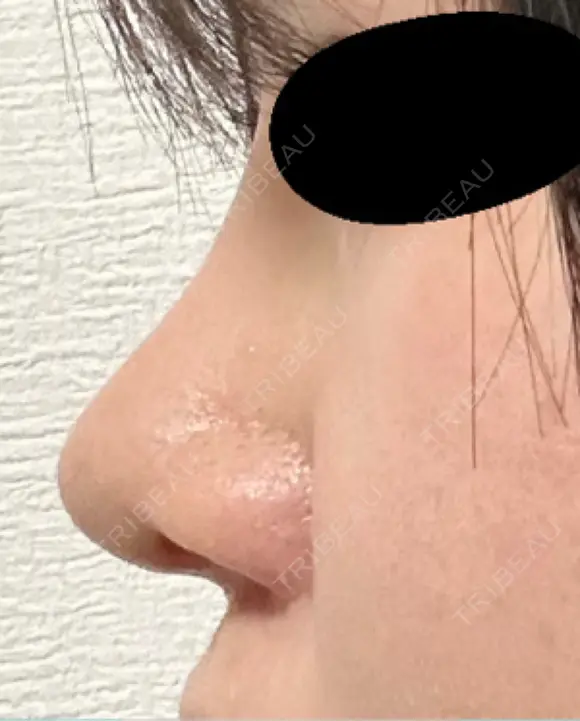 隆鼻術 / 鼻尖形成（切開） / 鼻中隔延長（切開） / 軟骨移植 / 鼻孔縁挙上 / 鼻翼基部形成（貴族手術） / 鼻柱下降・鼻唇角形成（猫手術） 4Dクリニック DAY 28 メイン用
