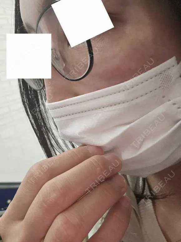 スネコス ミニマムスキンクリニック池袋 DAY 0 メイン用