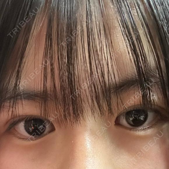 二重埋没 湘南美容クリニック 千葉センシティ院 DAY 5 メイン用
