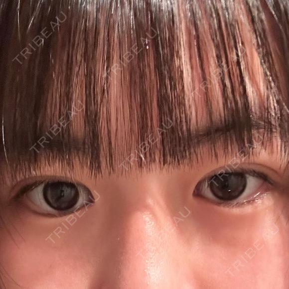 二重埋没 湘南美容クリニック 千葉センシティ院 DAY 6 メイン用
