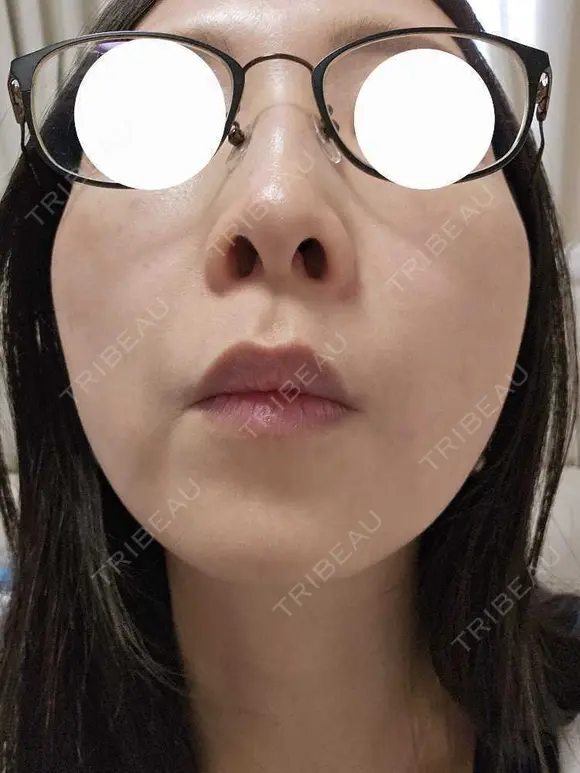 スネコス ミニマムスキンクリニック池袋 DAY 1 メイン用