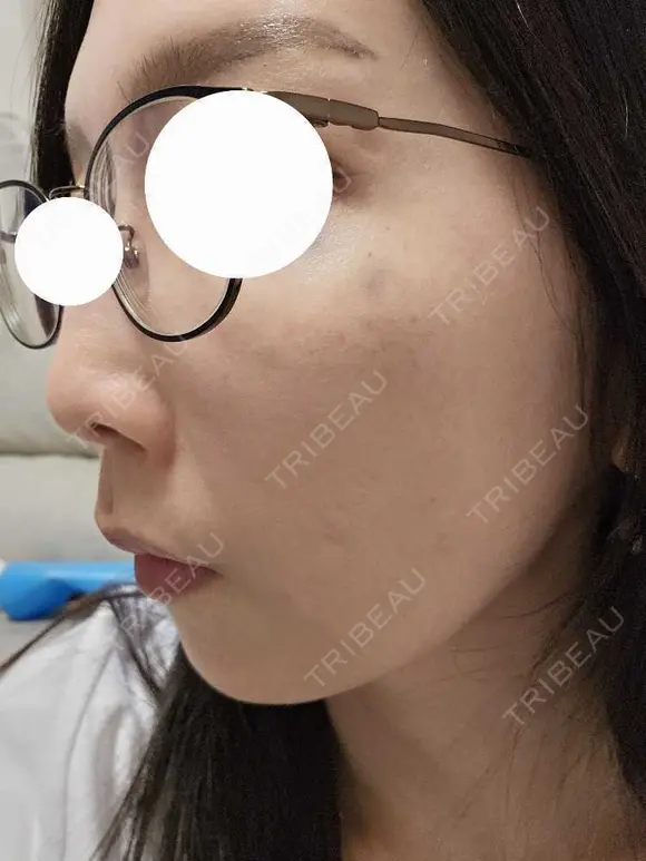 スネコス ミニマムスキンクリニック池袋 DAY 1 メイン用