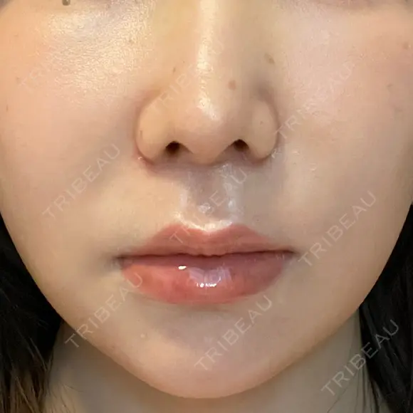 人中短縮 聖心美容クリニック 六本木院 AFTER メイン用
