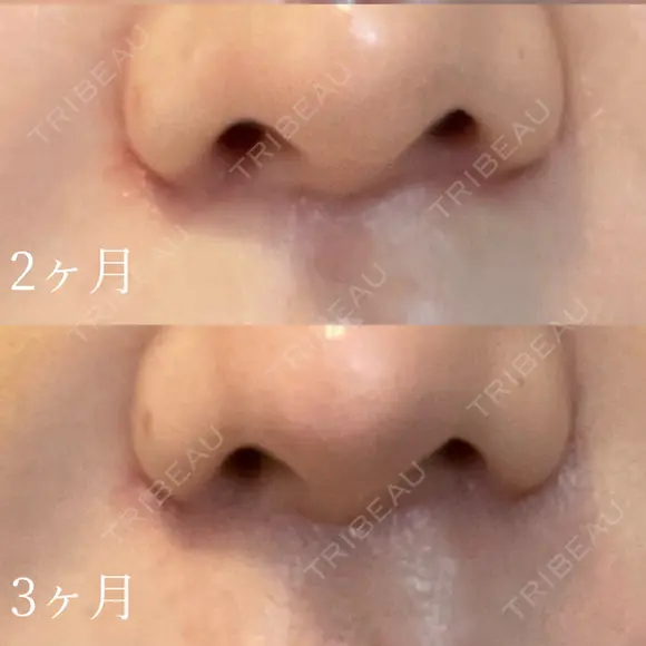 人中短縮 聖心美容クリニック 六本木院 DAY 92 メイン用