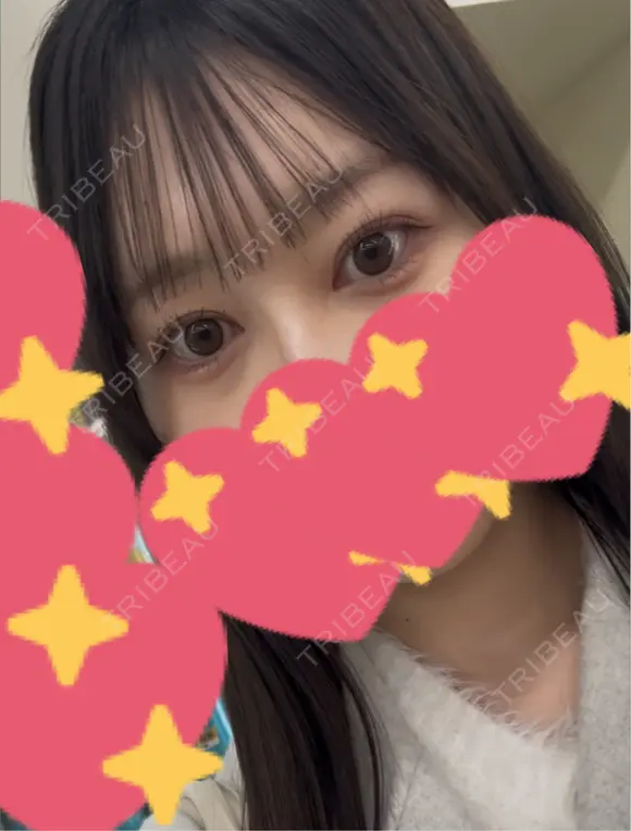 目頭切開 Brandnew Beauty Clinic DAY 132 メイン用