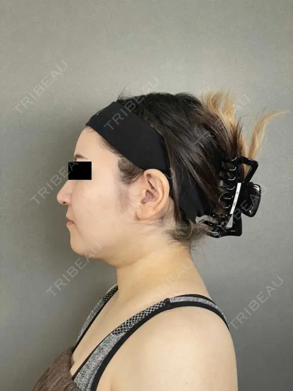 糸リフト / バッカルファット除去 / 脂肪吸引（顔） / メーラーファット除去 / ジョールファット除去 / ボトックス（エラ・小顔） アリエル美容クリニック 大宮院 DAY 35 メイン用
