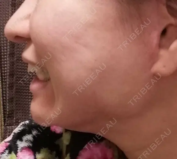 矯正（マウスピース） 銀座青山You矯正歯科 池袋西口医院 DAY 395 メイン用