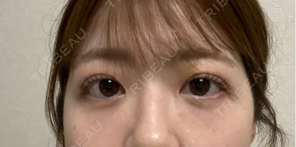 二重埋没 湘南美容クリニック 千葉センシティ院 DAY 6 メイン用