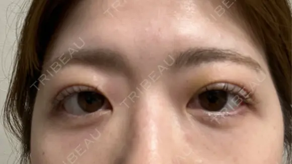 二重埋没 湘南美容クリニック 千葉センシティ院 DAY 7 メイン用