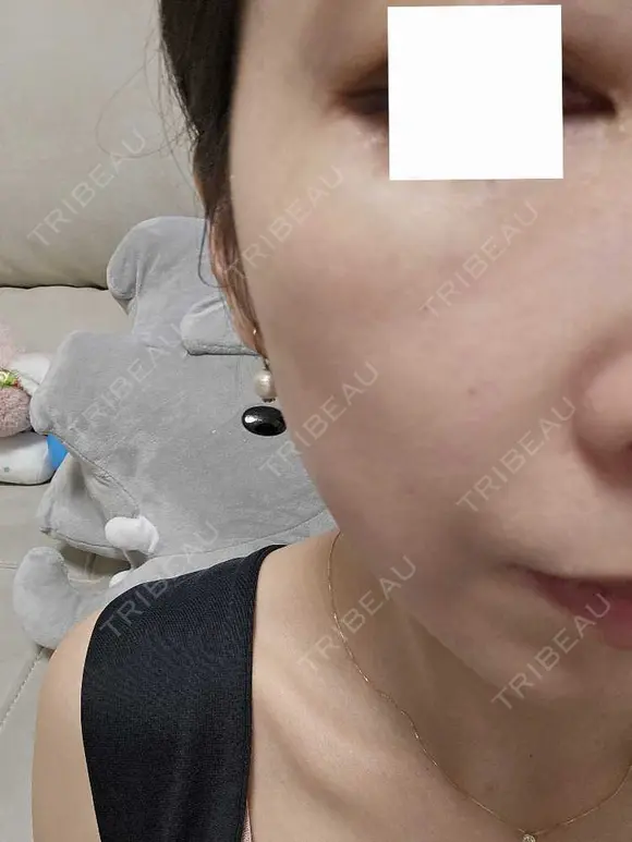 スネコス ミニマムスキンクリニック池袋 DAY 2 メイン用