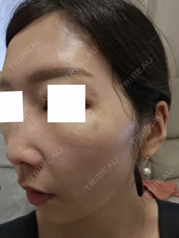 スネコス ミニマムスキンクリニック池袋 DAY 2 メイン用