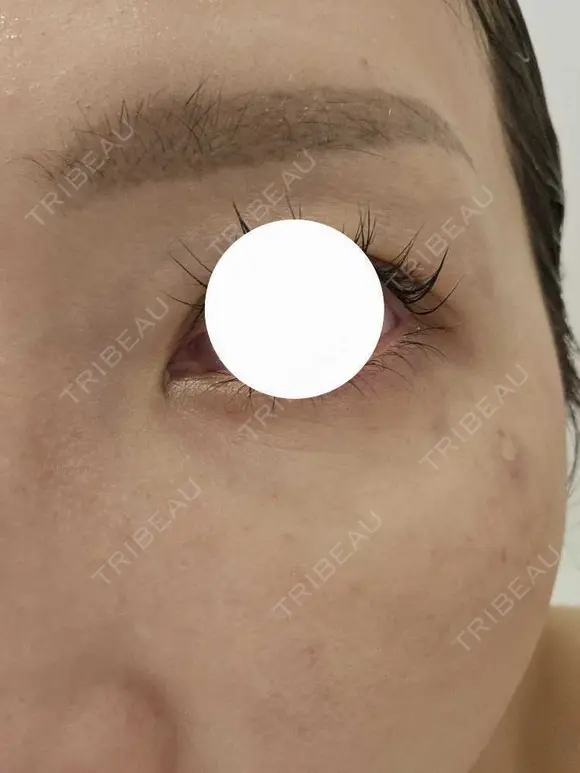 スネコス ミニマムスキンクリニック池袋 AFTER メイン用