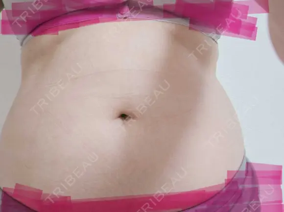 脂肪冷却（二の腕） / 脂肪冷却（お尻） DMTC CLINIC 渋谷院 DAY 17 メイン用