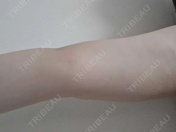 脂肪冷却（二の腕） / 脂肪冷却（お尻） DMTC CLINIC 渋谷院 DAY 17 メイン用