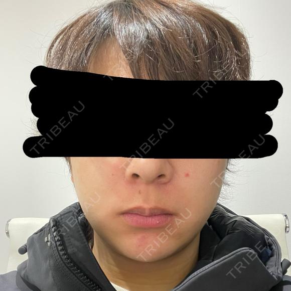 糸リフト / 脂肪吸引（顔） / 脂肪吸引注射（顔） / ヒアルロン酸注入（あご） SEA CLINIC（シークリニック） DAY 5 メイン用