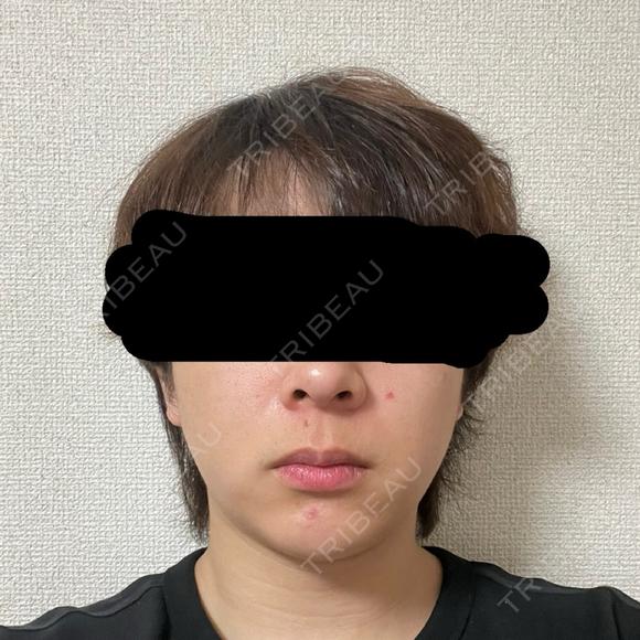 糸リフト / 脂肪吸引（顔） / 脂肪吸引注射（顔） / ヒアルロン酸注入（あご） SEA CLINIC（シークリニック） DAY 15 メイン用