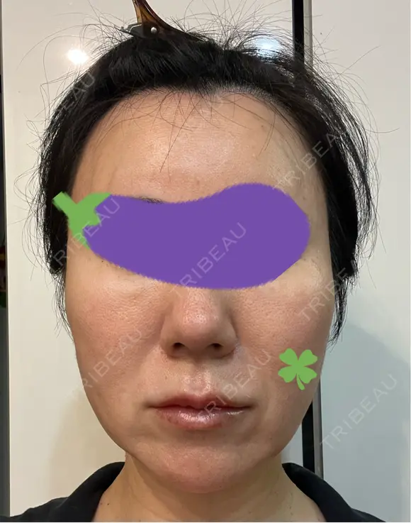 糸リフト Olino美容外科・美容皮膚科 DAY 13 メイン用