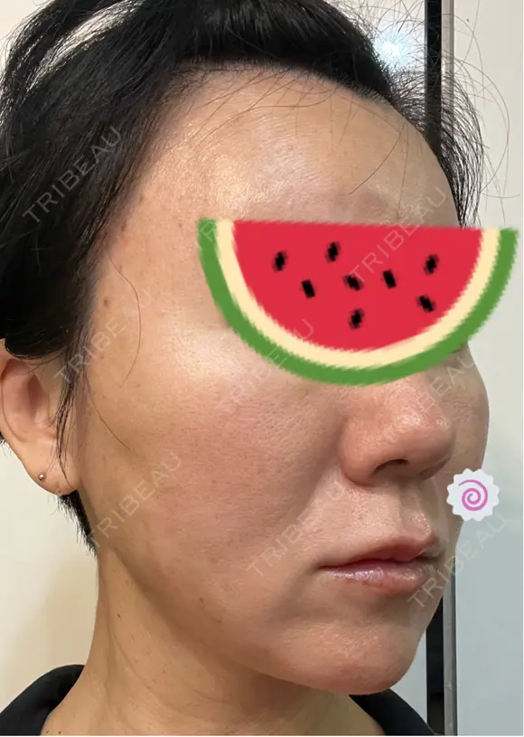 糸リフト Olino美容外科・美容皮膚科 DAY 13 メイン用