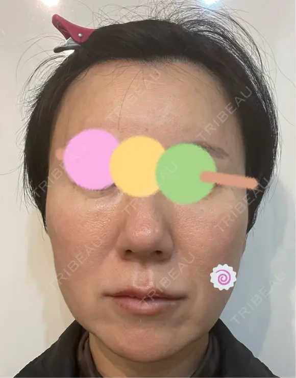 糸リフト Olino美容外科・美容皮膚科 DAY 35 メイン用