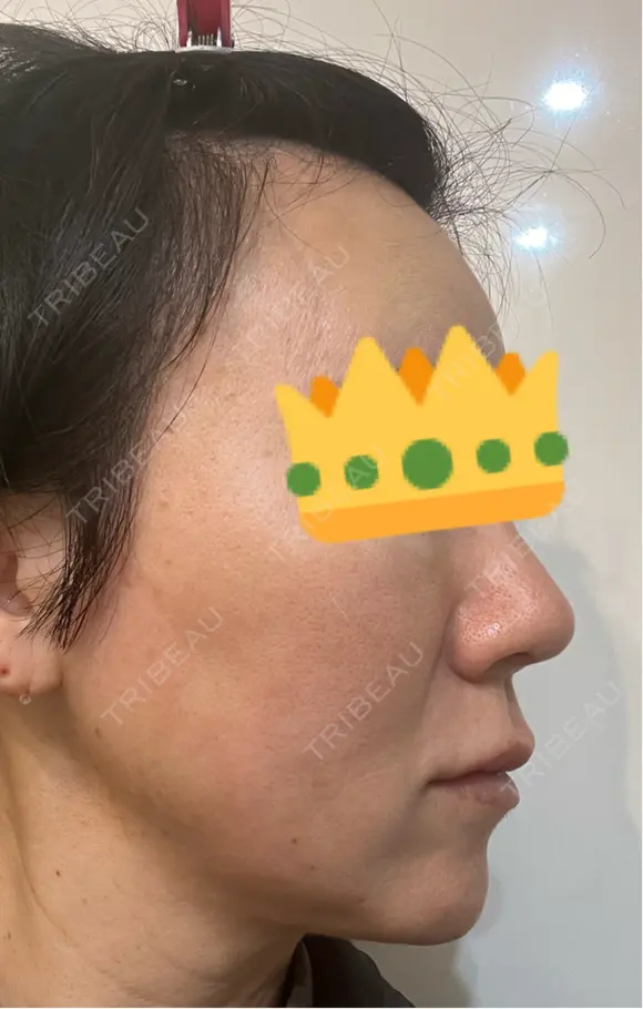 糸リフト Olino美容外科・美容皮膚科 DAY 35 メイン用