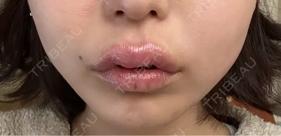 アートメイク（唇） 表参道メディカルクリニック 名古屋院 DAY 21 メイン用