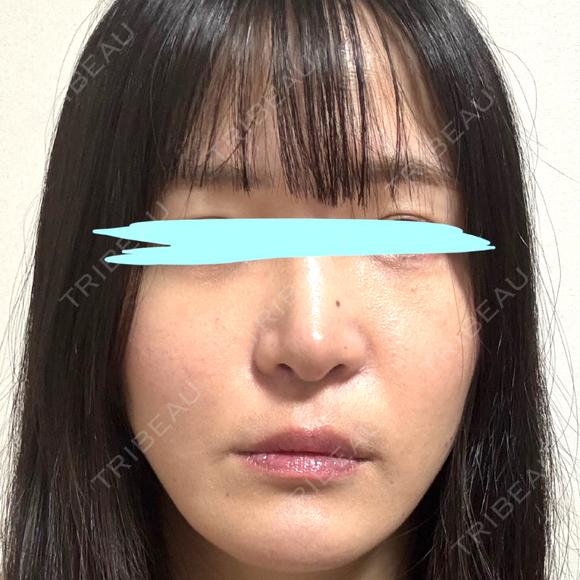 小鼻縮小（切開） / 鼻翼基部形成（貴族手術） 新宿ラクル美容外科クリニック 新宿院 DAY 50 メイン用