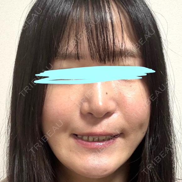 小鼻縮小（切開） / 鼻翼基部形成（貴族手術） 新宿ラクル美容外科クリニック 新宿院 DAY 50 メイン用