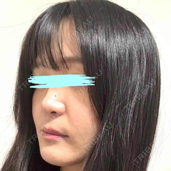 小鼻縮小（切開） / 鼻翼基部形成（貴族手術） 新宿ラクル美容外科クリニック 新宿院 DAY 50 メイン用
