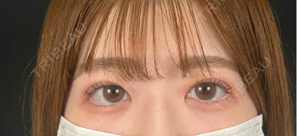 二重埋没 湘南美容クリニック 千葉センシティ院 AFTER メイン用
