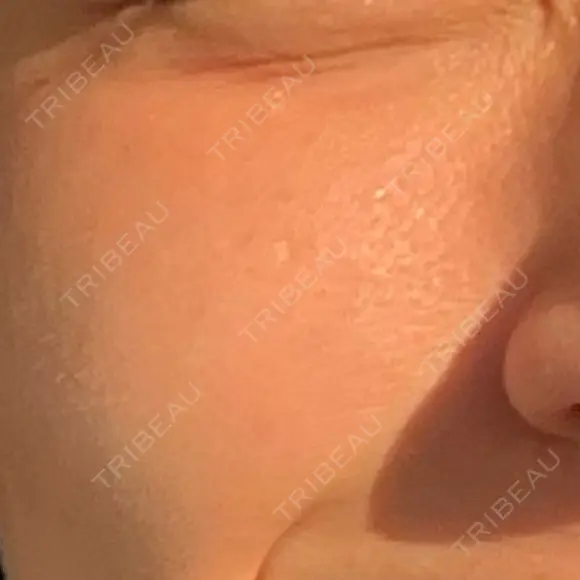 ヴェルヴェットスキン ゆう美容クリニック AFTER メイン用