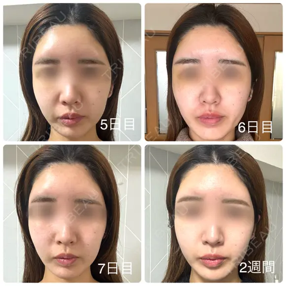 額を丸く / こめかみ形成 / 脂肪注入（額） 湘南美容クリニック 吉祥寺院 DAY 1 メイン用