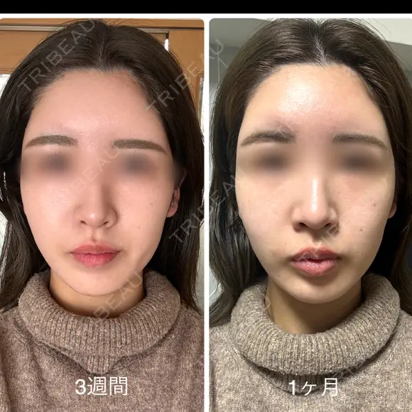 額を丸く / こめかみ形成 / 脂肪注入（額） 湘南美容クリニック 吉祥寺院 DAY 1 メイン用