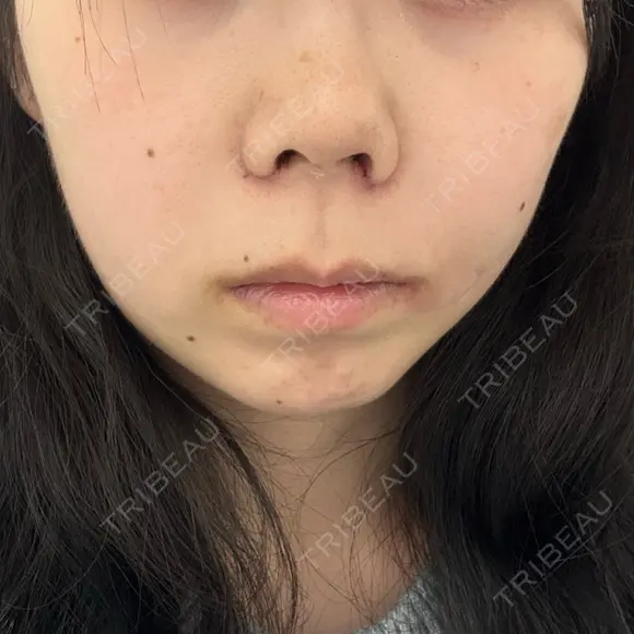 鼻尖形成（切開） / 小鼻縮小（切開） / 軟骨移植 RIVER CLINIC（リバークリニック） DAY 6 メイン用