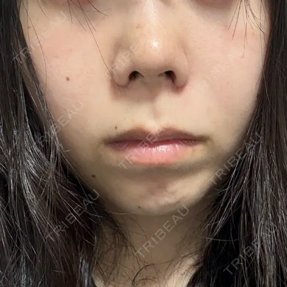 鼻尖形成（切開） / 小鼻縮小（切開） / 軟骨移植 RIVER CLINIC（リバークリニック） DAY 8 メイン用