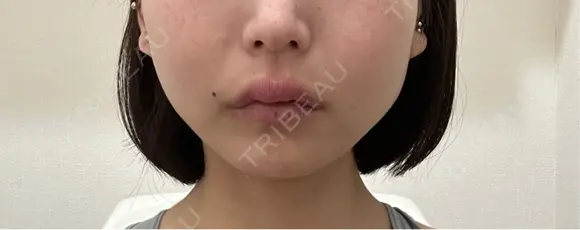 アートメイク（唇） 表参道メディカルクリニック 名古屋院 DAY 22 メイン用