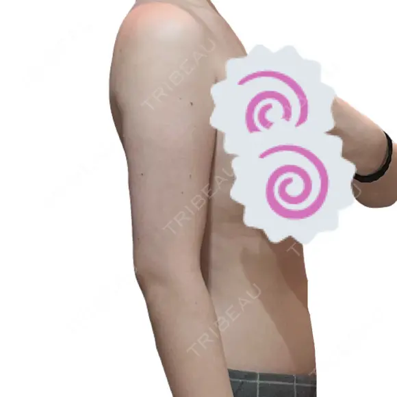 糸リフト / 脂肪吸引（顔） / 脂肪吸引（二の腕） / ワキ汗治療（切開） / 脂肪吸引注射（顔） ICON CLINIC DAY 31 メイン用