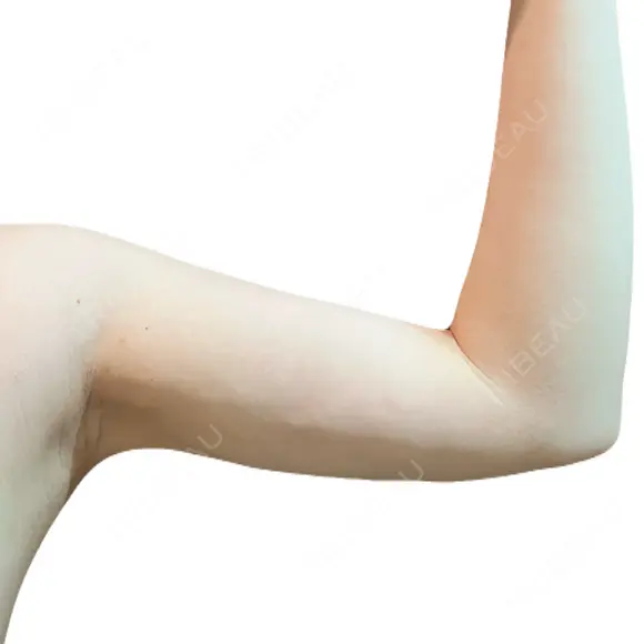 糸リフト / 脂肪吸引（顔） / 脂肪吸引（二の腕） / ワキ汗治療（切開） / 脂肪吸引注射（顔） ICON CLINIC DAY 31 メイン用