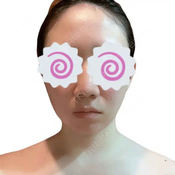 糸リフト / 脂肪吸引（顔） / 脂肪吸引（二の腕） / ワキ汗治療（切開） / 脂肪吸引注射（顔） ICON CLINIC DAY 31 メイン用