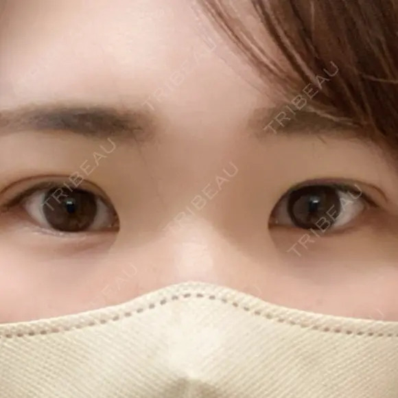 二重埋没 / 上まぶたの脂肪取り / 脂肪溶解注射（顔） TCB東京中央美容外科 前橋院 DAY 8 メイン用