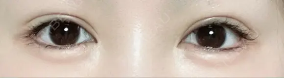 二重切開 / 眼瞼下垂（切開） ユア美容クリニック 福岡院 AFTER メイン用