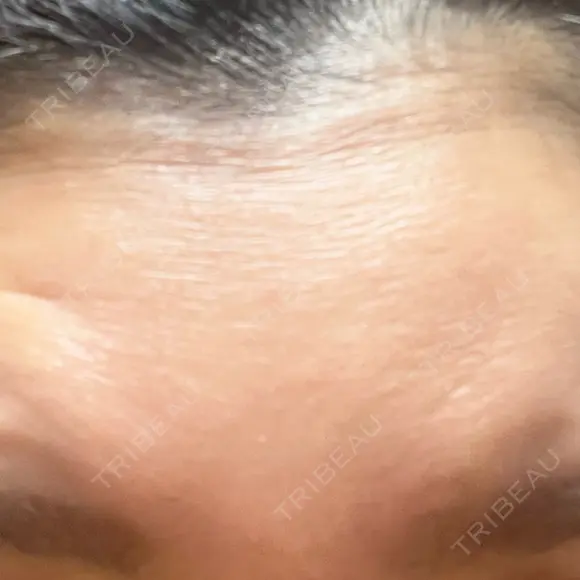 シワ取りボトックス 湘南美容クリニック 新横浜院 AFTER メイン用