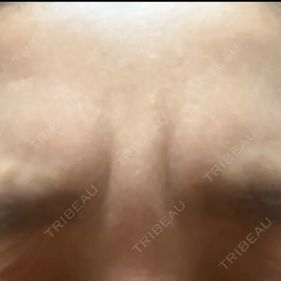 シワ取りボトックス 湘南美容クリニック 新横浜院 DAY 1 メイン用