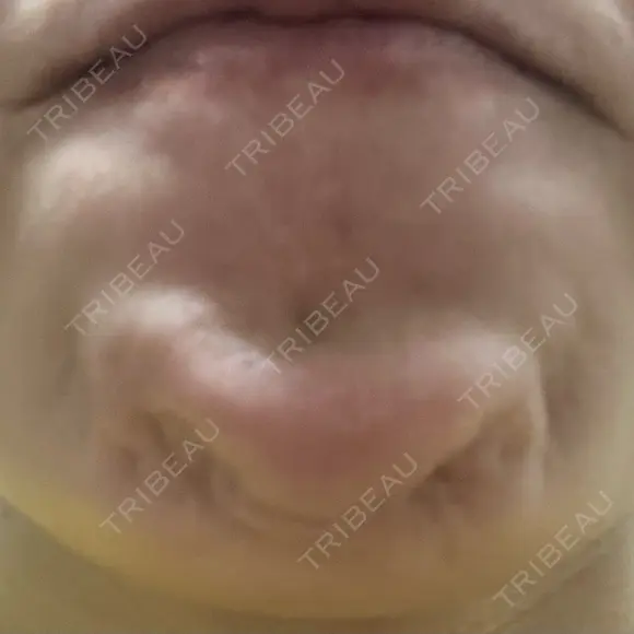 シワ取りボトックス 湘南美容クリニック 新横浜院 DAY 1 メイン用