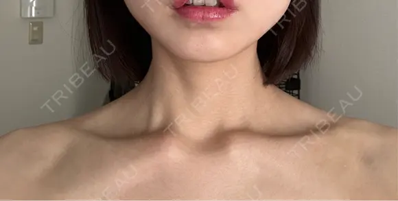 ボトックス（肩） ルラ美容クリニック 名古屋本院 DAY 2 メイン用